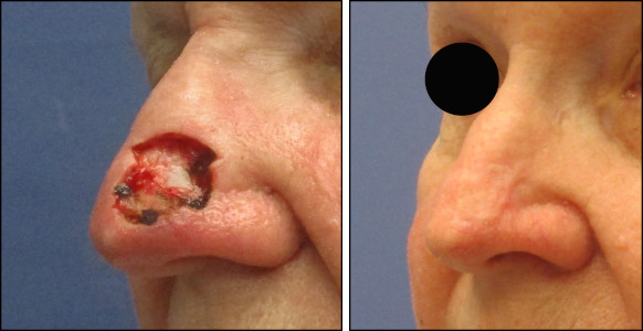 facelift
